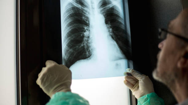 istock Roentgen shot of lungs 1214746093