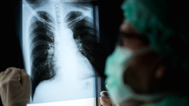 istock Roentgen shot of lungs 1214746203