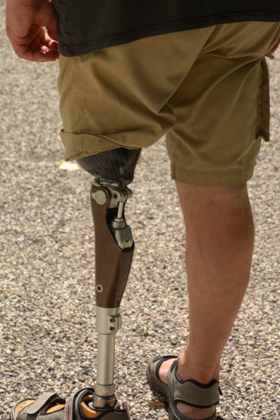 istock left leg prosthesis self-assured man wearing shorts 1214784764