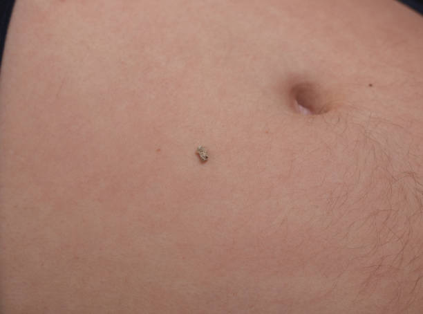5 mm kidney stone laying on naked belly 5 mm kidney stone laying on naked belly magnesium deficiency stock pictures, royalty-free photos & images