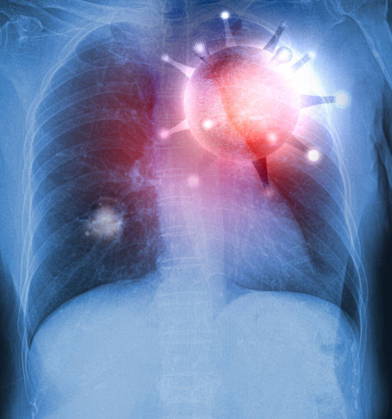 x-rays film płuc z wirusem covid-19, odpowiedzialny za epidemię grypy azjatyckiej - ray trace zdjęcia i obrazy z banku zdjęć