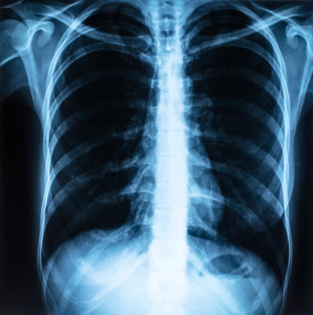istock Radiographic image or X-Ray Image of Human Chest 1214858269