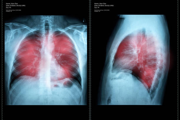 radiografia del petto maschile - human lung x ray image x ray human spine foto e immagini stock