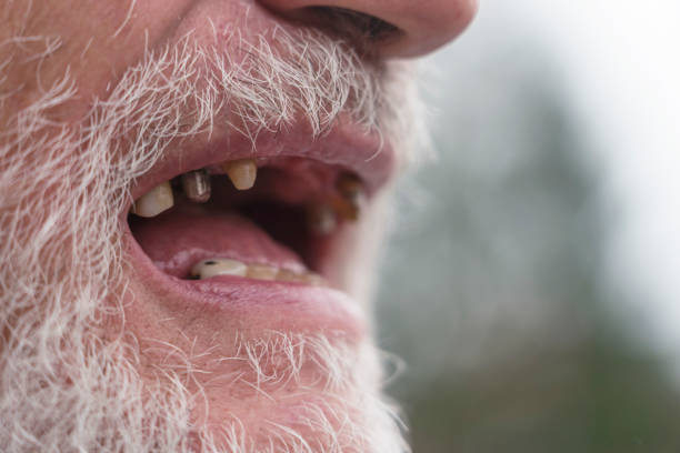 Mouth open of a senior man with bad teeth, short white beard.