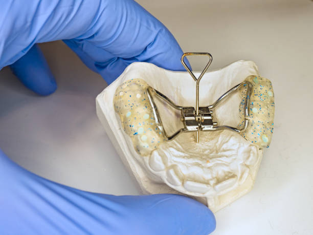 Teeth gypsum model with Hyrax Expander braces stock photo