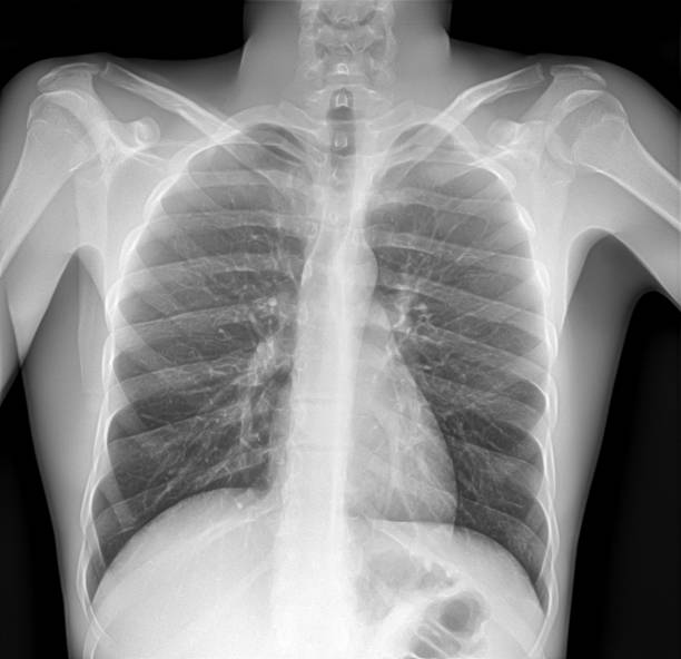 肺炎を伴う肺のx線画像 - pain rib cage x ray image chest ストックフォトと画像