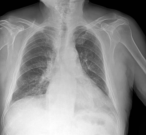 肺炎を伴う肺のx線画像 - pain rib cage x ray image chest ストックフォトと画像