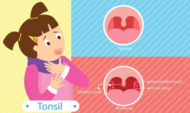 ilustrações, clipart, desenhos animados e ícones de amigdalite - tonsillitis