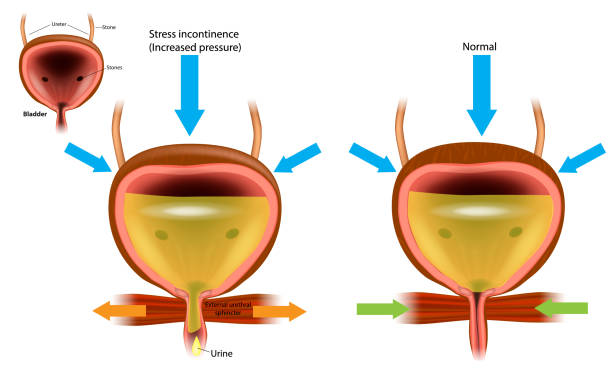 harninkontinenz (ui), auch bekannt als unfreiwilliges wasserlassen. - urethral sphincter stock-grafiken, -clipart, -cartoons und -symbole