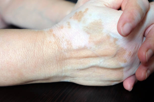 istock Woman's hands folded. The skin is stained with vitiligo. 1215238767