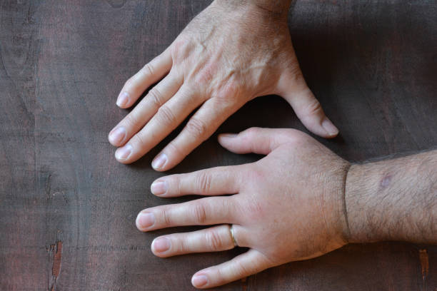 Swollen fist compared with healthy fist A swollen fist from a sting of a wasp compared to a healthy fist over dark wooden background 2273 stock pictures, royalty-free photos & images