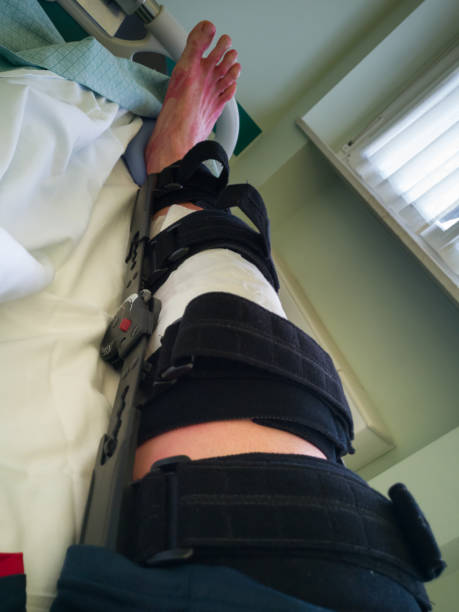 menschliches bein mit patches und orthopädischer korsett nach vorderer kreuzbandoperation: im bett im krankenhaus - cruciate ligament stock-fotos und bilder