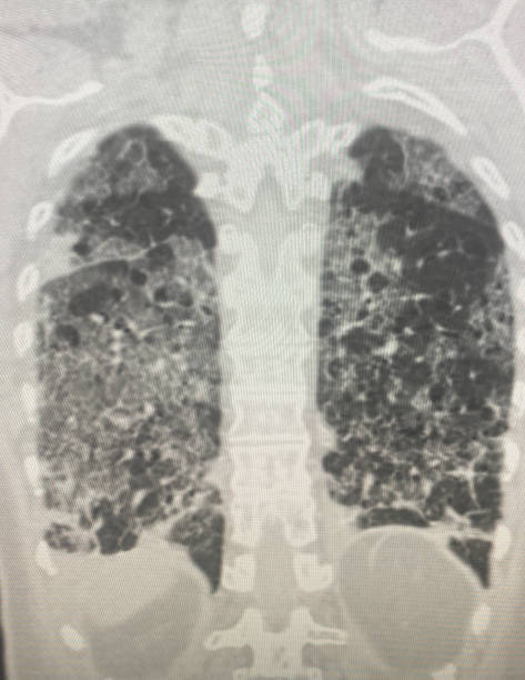 кт грудной клетки нового коронавируса covid-19 - x ray x ray image chest human lung стоковые фото и изображения