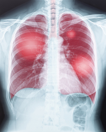 COVID-19, Coronavirus disease or tuberculosis infection on lung chest X-ray radiography imaging film displaying respiratory illness of woman patient's health in medical diagnostic analysis