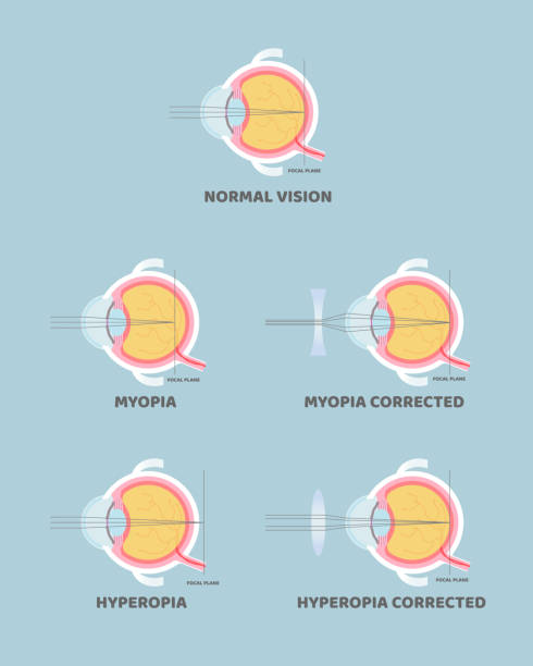 анатомия глазного яблока, внутренние органы тела часть нервной системы, близорукие, близорукие, дальновидные, дальновидные, гиперопия и бл� - хрусталик иллюстрации stock illustrations