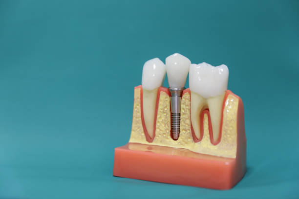 istock dental implant model 1215590935