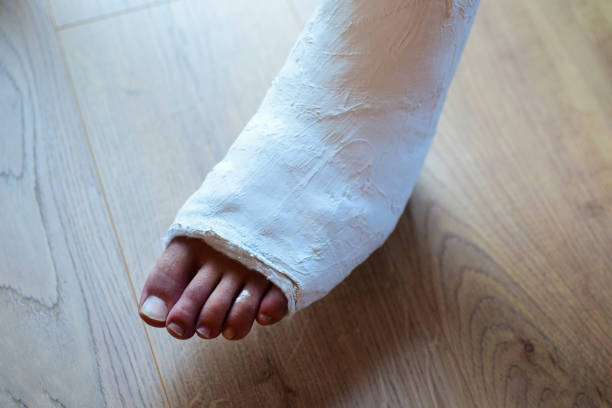 istock Fracture of the lower leg in a cast. 1215597204