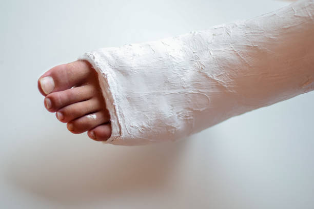 istock Fracture of the lower leg in a cast. 1215597213