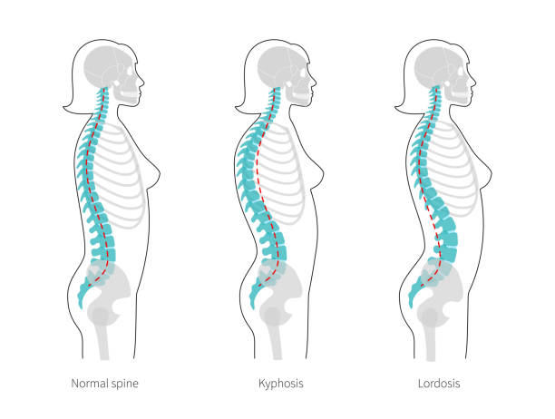 Kyphosis, lordosis flat vector illustration. Woman spinal deformity flat vector illustration. Kyphosis, lordosis of spine. Diagram with spine curvatures and healthy backbone. Body posture defect. Medical, educational and science banner kyphosis stock illustrations
