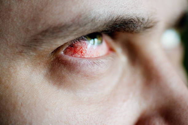 how do you get rid of red eyes after crying