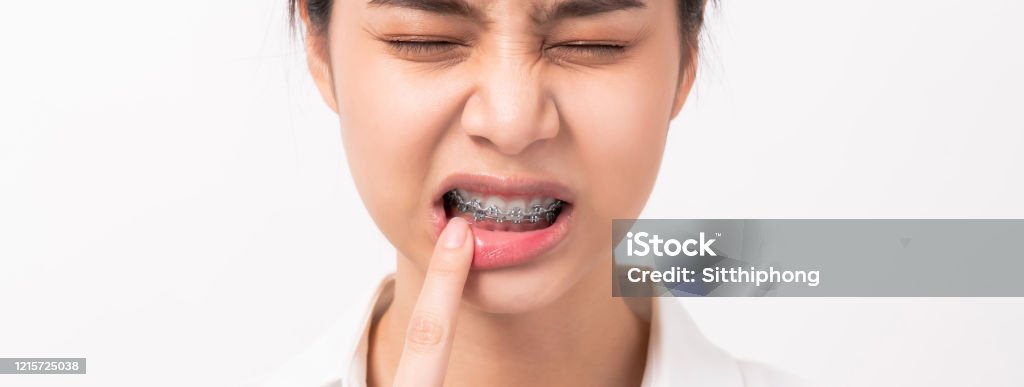 Face of asian woman finger touches a toothache maybe because of poor care. Dental Braces Stock Photo