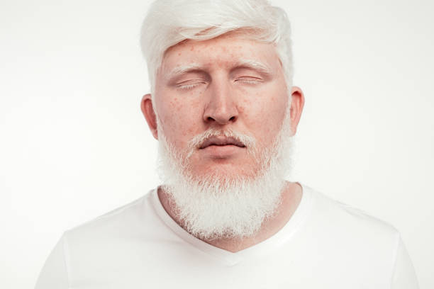 istock Freckled albino man with closed eyes 1215733631