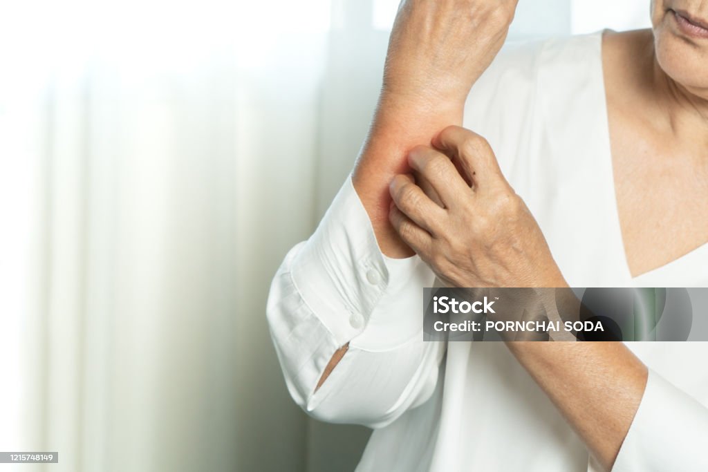 Seniorinnen kratzen Hand den Juckreiz auf Ekzem Arm, Gesundheitsversorgung und Medizin Konzept - Lizenzfrei Kratzen Stock-Foto