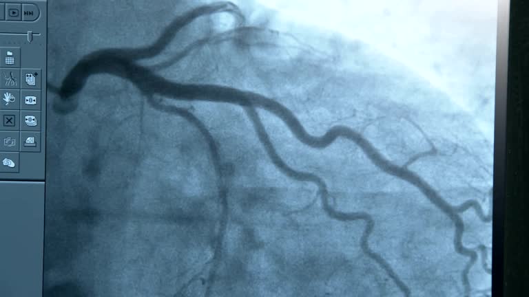 Angiogram Stock Videos and Royalty-Free Footage - iStock Angiogram Stock Videos and Royalty-Free Footage - iStock