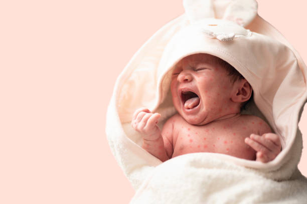 Measles baby stock photo