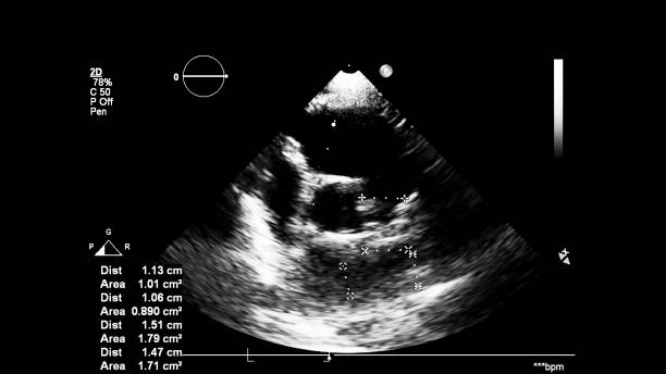 изображение сердца во время трансезофагеального ультразвука. - pulmonary valve стоковые фото и изображения