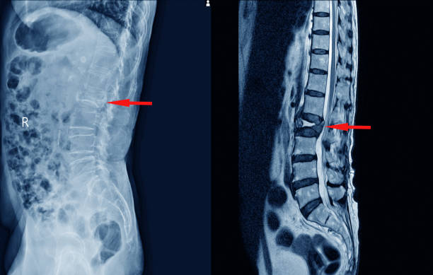 fracture médicale de compression lombaire de la colonne x-ray bulging de l1-2. - dégénératif photos et images de collection