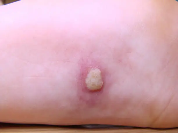 Herpis on the baby's leg is a disease with a characteristic close-up photo rash