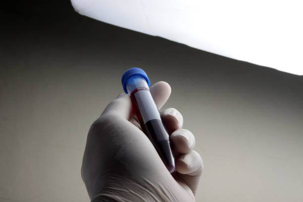 istock Blood sample from patient placed into test tube 1216053698