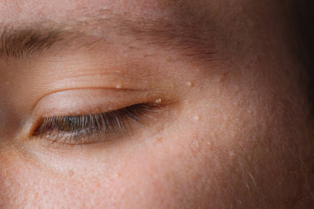 Milia (Milium) - pimples around eye on skin. Eyes of young man with small papillomas on eyelids or growths on skin. Milia (Milium) - pimples around eye on skin. Eyes of young man with small papillomas on eyelids or growths on skin. Face closeup. cnidarian stock pictures, royalty-free photos & images