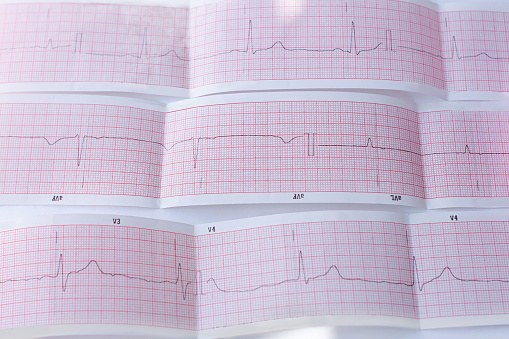 Electrocardiogram with ventricular stimulated pacemaker rhythm
