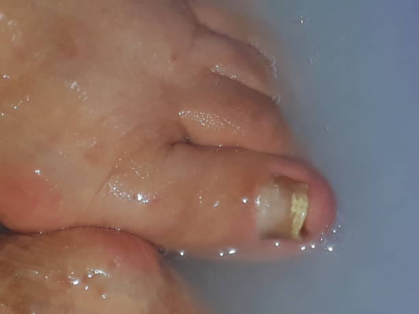 istock human foot with toenail fungus 1216247267