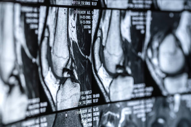 Magnetic resonance imaging (MRI) scan of knee-joint
