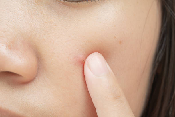 istock Facial acne and skin inflammation 1216294185