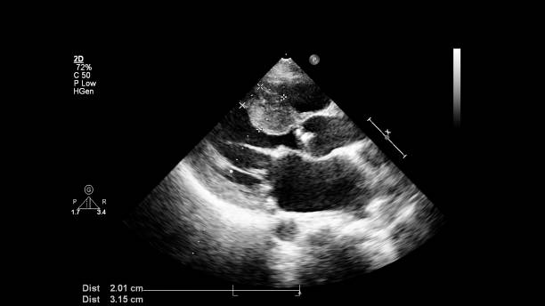 経食道超音波中の心臓の画像。 - pulmonary valve ストックフォトと画像