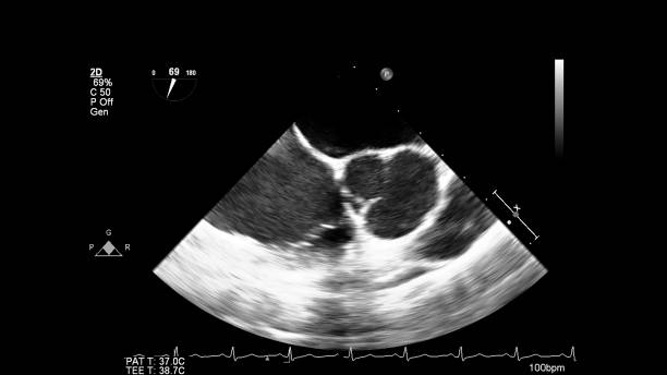 изображение сердца во время трансезофагеального ультразвука. - pulmonary valve стоковые фото и изображения