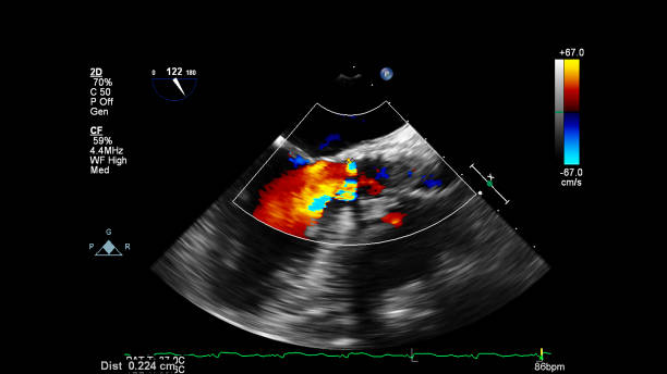 経食道超音波中の心臓の画像。 - pulmonary valve ストックフォトと画像