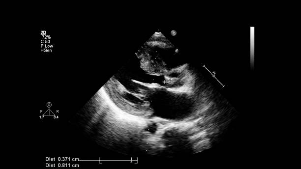 経食道超音波中の心臓の画像。 - pulmonary valve ストックフォトと画像
