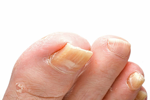istock Toenail Fungus 121636187
