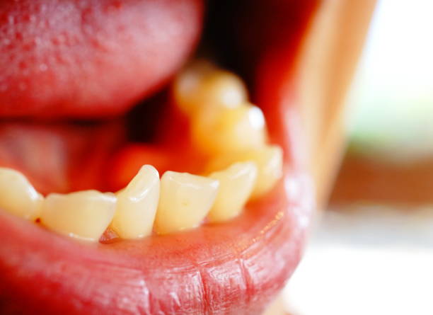 Close-up shot of crooked teeth with open mouth.