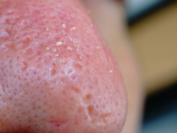 istock Close-up pimple on nose with man 1216510627