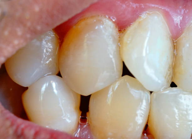 istock Poor dental hygiene. Plaque on teeth 1216510679
