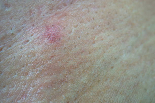 istock close-up acne on skin 1216510695