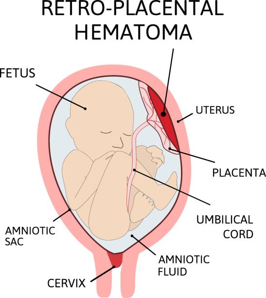 ilustrações de stock, clip art, desenhos animados e ícones de placental hematoma. blood clots that arise from the placenta. - placenta baby childbirth newborn