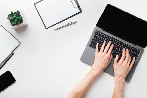 istock Female hands with vitiligo working on modern laptop 1216755399