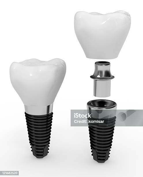 Due Impianti Dentali Su Sfondo Bianco - Fotografie stock e altre immagini di Apparecchiatura odontoiatrica - Apparecchiatura odontoiatrica, Composizione verticale, Denti umani